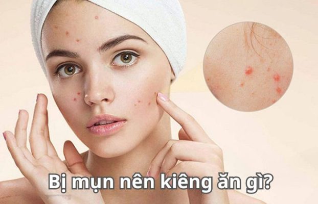 Bị mụn nên kiêng ăn gì