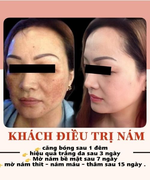 Phản hồi của khách về Kem trị nám Quê Skin