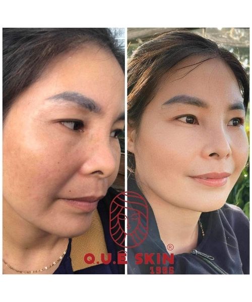 Phản hồi của khách về Kem trị nám Quê Skin