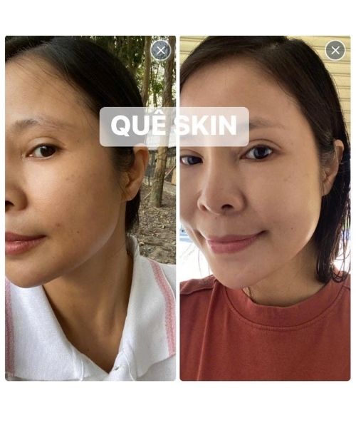 Phản hồi của khách về Kem trị nám Quê Skin