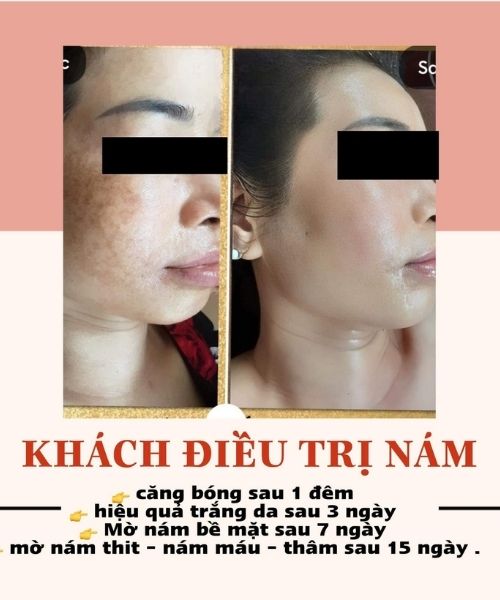 Phản hồi của khách về Kem trị nám Quê Skin