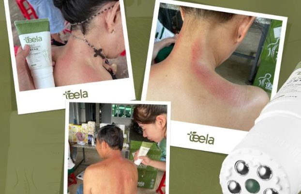 Trị đau mỏi cổ vai gáy tại nhà với Kem massage Teela